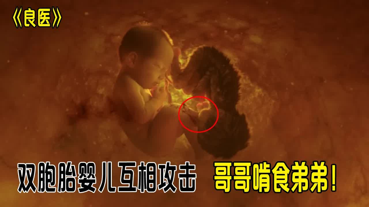 双胞胎婴儿互相攻击，哥哥一直啃食弟弟，要杀死对方《良医》